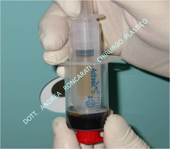 PLASMA ARRICCHITO di PIASTRINE